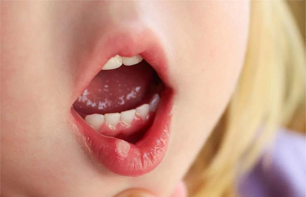 Chữa nhiệt miệng bằng mật ong nhanh