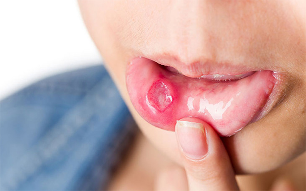 Chữa nhiệt miệng bằng mật ong hiệu quả